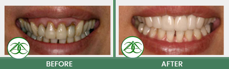 Porcelain Veneers at Allure Dental Center in Mountain View, CA