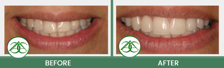 Porcelain Veneers at Allure Dental Center in Mountain View, CA