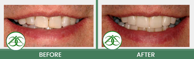 Porcelain Veneers at Allure Dental Center in Mountain View, CA