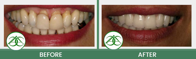 Porcelain Veneers at Allure Dental Center in Mountain View, CA