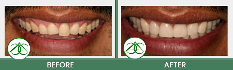 Porcelain Veneers at Allure Dental Center in Mountain View, CA