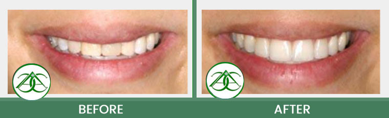 Porcelain Veneers at Allure Dental Center in Mountain View, CA