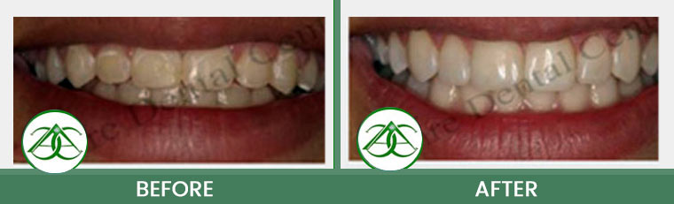 Smile Makeover at Allure Dental Center in Mountain View, CA
