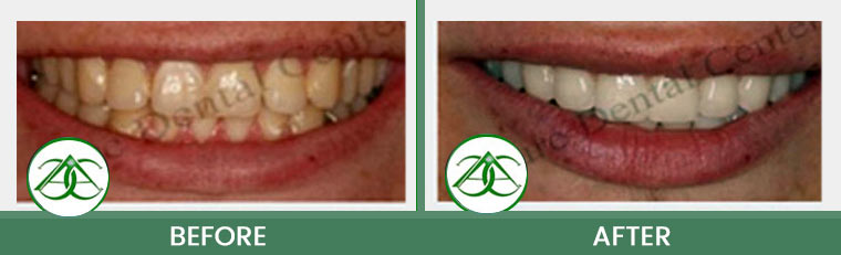 Smile Makeover at Allure Dental Center in Mountain View, CA