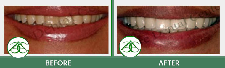 Smile Makeover at Allure Dental Center in Mountain View, CA