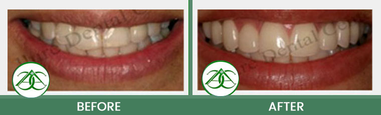 Smile Makeover at Allure Dental Center in Mountain View, CA