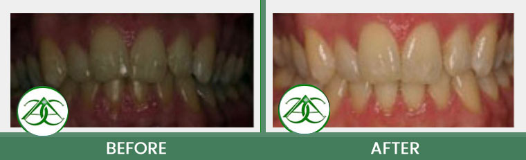 Tissue Graft at Allure Dental Center in Mountain View, CA