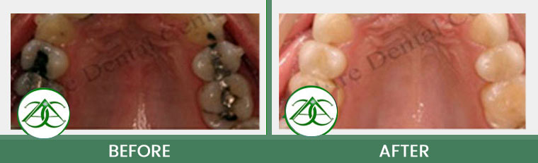 Tooth-Colored Fillings (Anterior and Posterior) at Allure Dental Center in Mountain View, CA