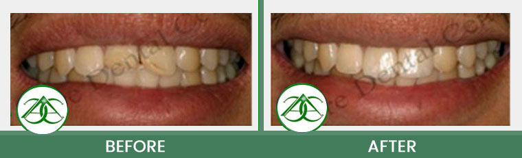 Tooth-Colored Fillings (Anterior and Posterior) at Allure Dental Center in Mountain View, CA