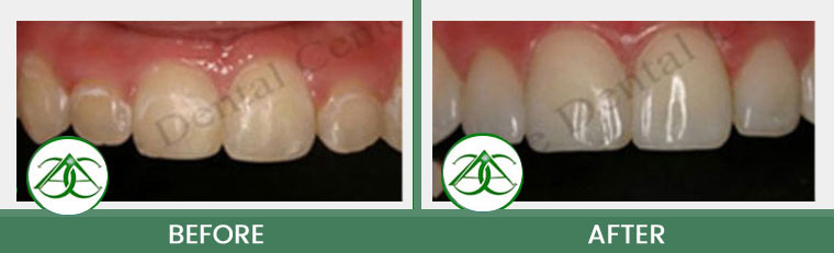 Tooth-Colored Fillings (Anterior and Posterior) at Allure Dental Center in Mountain View, CA
