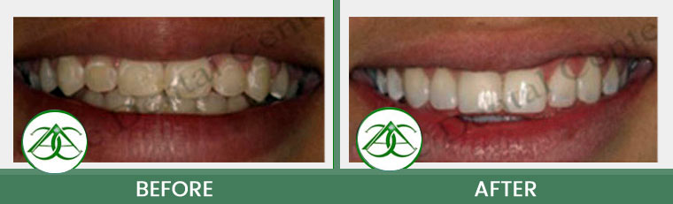 Tooth-Colored Fillings (Anterior and Posterior) at Allure Dental Center in Mountain View, CA