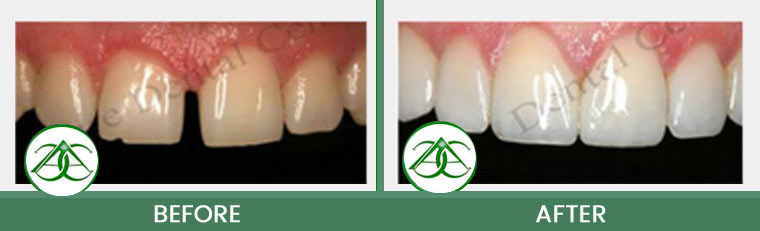 Tooth-Colored Fillings (Anterior and Posterior) at Allure Dental Center in Mountain View, CA