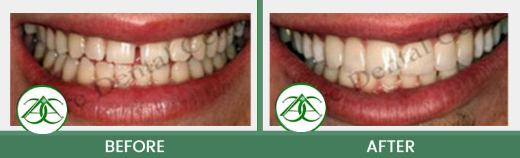 Tooth-Colored Fillings (Anterior and Posterior) at Allure Dental Center in Mountain View, CA