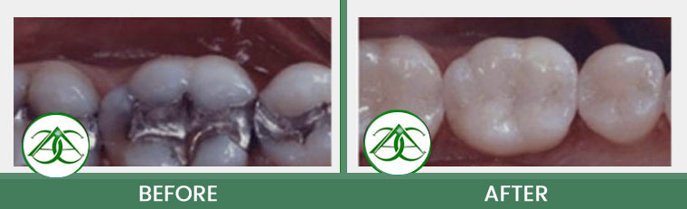 Tooth-Colored Fillings (Anterior and Posterior) at Allure Dental Center in Mountain View, CA