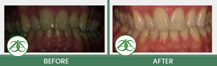 Tooth-Colored Fillings (Anterior and Posterior) at Allure Dental Center in Mountain View, CA