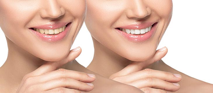 Yellow Teeth Treatment Options Near Me in Mountain View, CA Yellow Teeth Treatment Options Near Me in Mountain View, CA